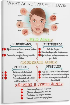 Different Types of Acne Poster (1) Canvas Print Wall Art Decor Living Room Office Bedroom 12x18inch(30x45cm) Frame-style